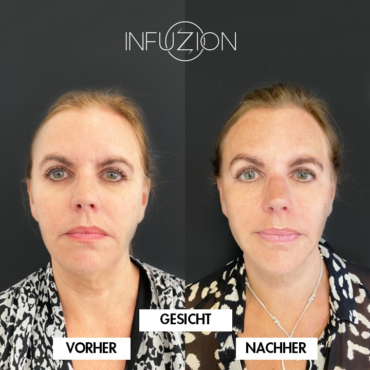 Infuzion® Vorher-Nachher-Beispiel des Herstellers, Bild 3 von 3