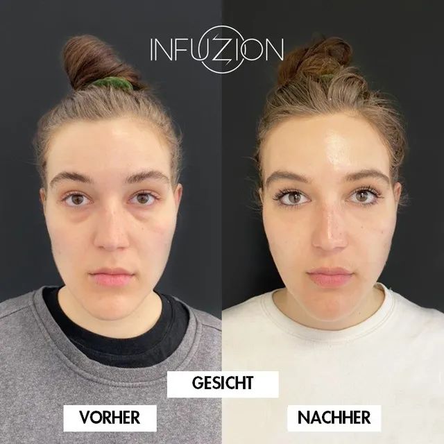 Infuzion® Vorher-Nachher-Beispiel des Herstellers, Bild 1 von 3