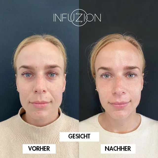 Infuzion® Vorher-Nachher-Beispiel des Herstellers, Bild 2 von 3